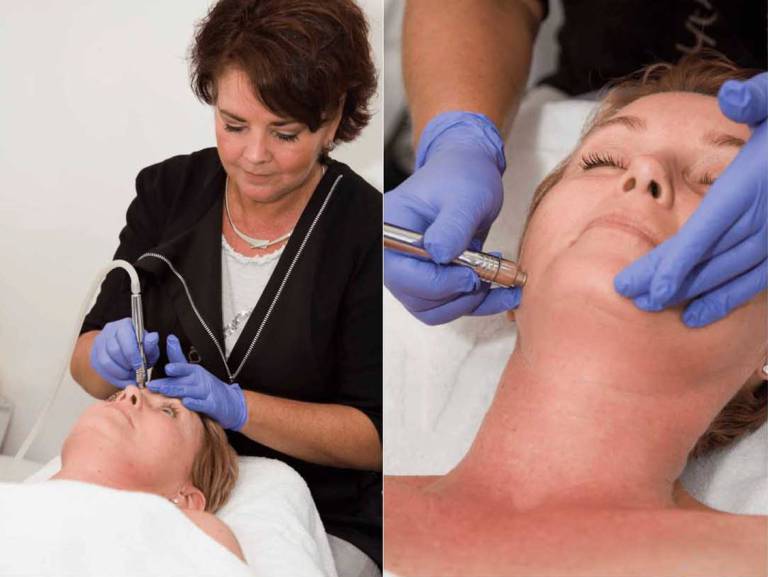 Microdermabrasie